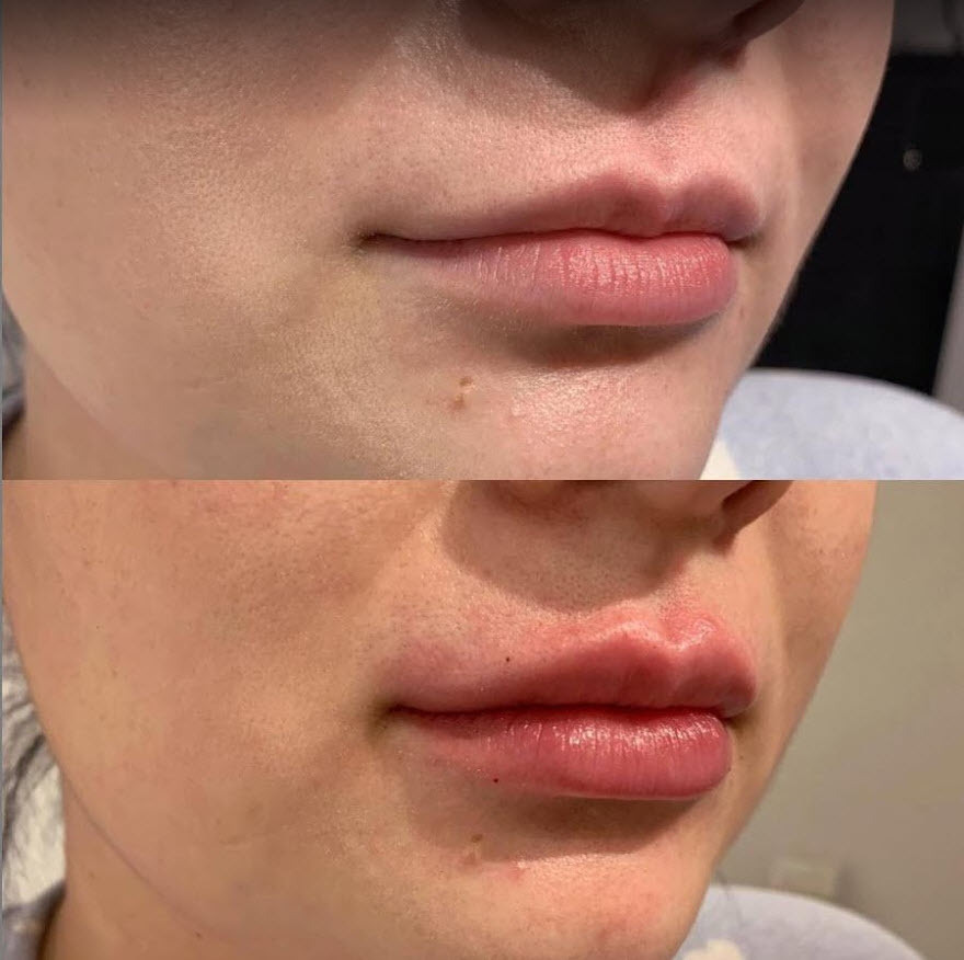 Calgary Lip filler injections medical spa 2.jpg