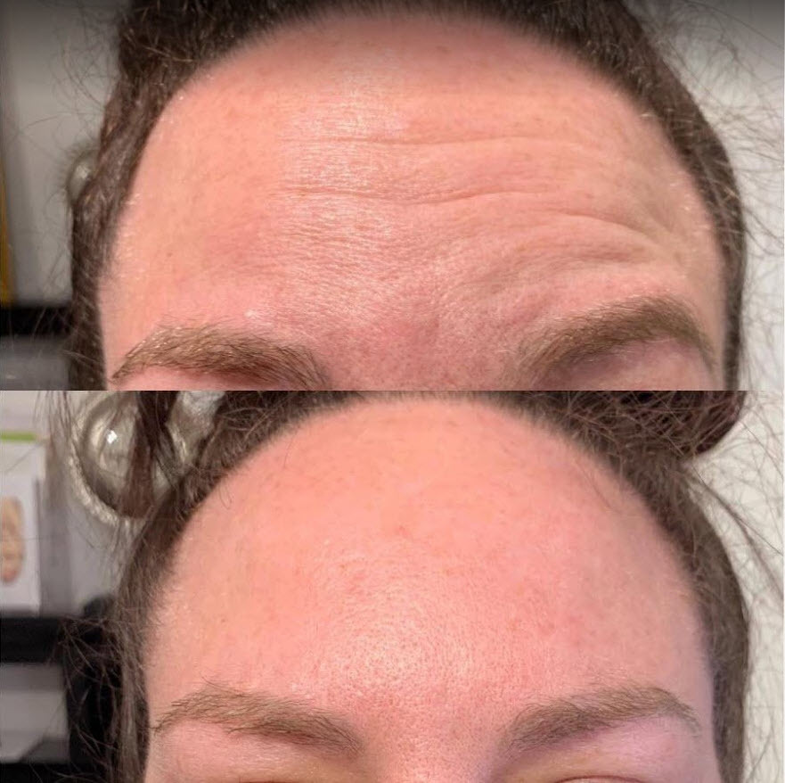 Calgary botox for forehead lines.jpg